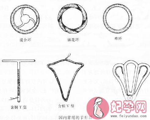 哪种避孕环比较好 避孕环存在哪些副作用