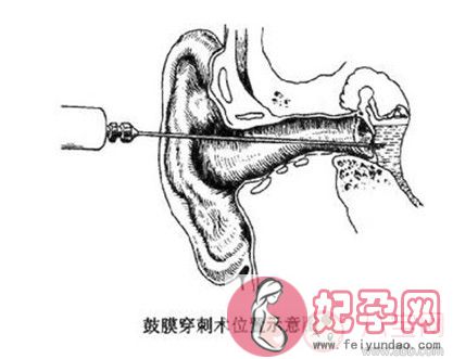 做完中耳炎手术后多久可以进行性生活 中耳炎手术之后会影响性生活吗