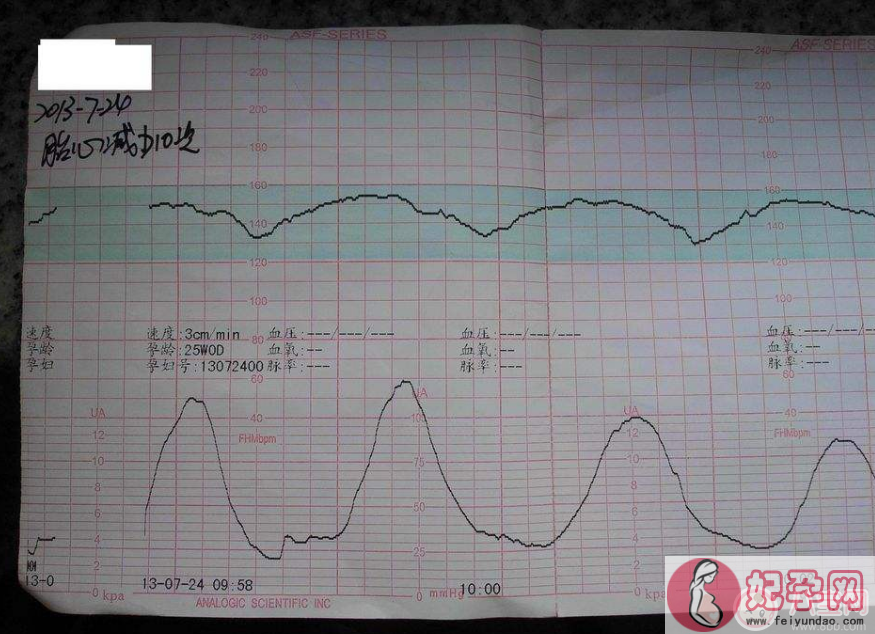 胎监评分怎么看 2018胎监评分多少分算正常