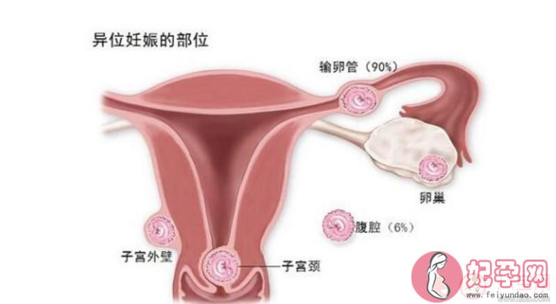 验血可以查出宫外孕吗 宫外孕手术后还能不能怀孕