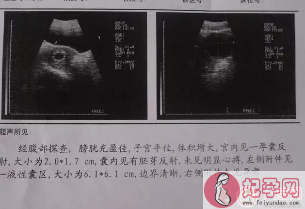怀三个月男孩孕妇的肚子图片   怀孕三个月生男孩有什么特征