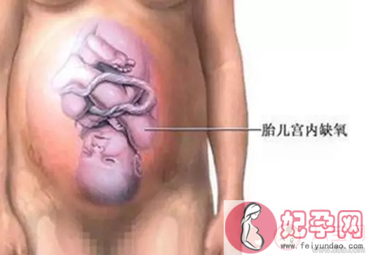胎宝宝打嗝说明不缺氧是真的吗 胎儿打嗝就能判断证明宫内没缺氧