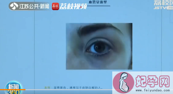 南京黑眼圈门诊开诊1年一号难求 黑眼圈该如何消除