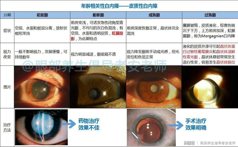 年龄相关性白内障失明（熬夜手机看小说）