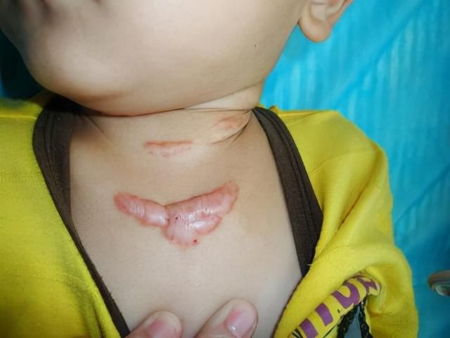 儿童烫伤疤痕增生怎么治疗（宝宝烫伤疤痕增生如何修复）(1)