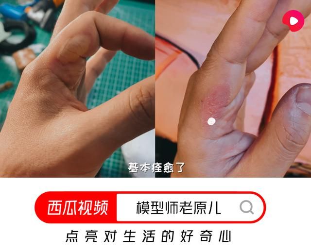 烫伤水泡能否刺破（烫伤的水泡不能轻易戳破）
