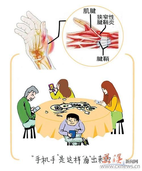 腱鞘炎是看手机引起的吗（玩手机太忘形小心）