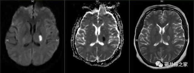 颅脑mri扫描的常用基线 颅脑MRI检查序列及临床应用(8)