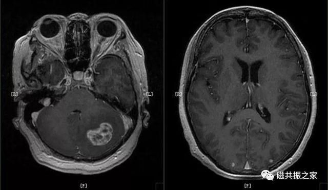 颅脑mri扫描的常用基线 颅脑MRI检查序列及临床应用(12)