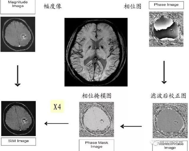 颅脑mri扫描的常用基线 颅脑MRI检查序列及临床应用(14)