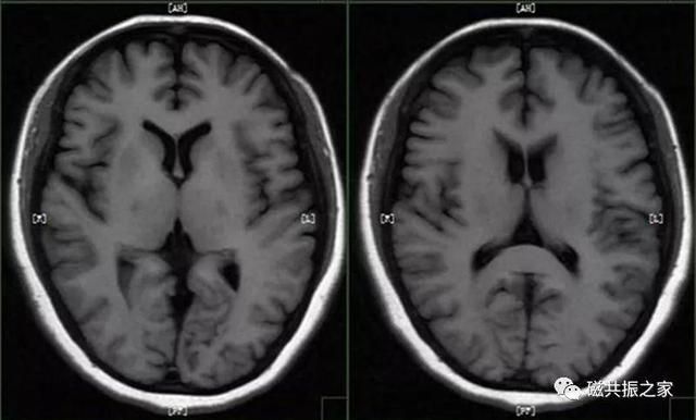 颅脑mri扫描的常用基线 颅脑MRI检查序列及临床应用(3)