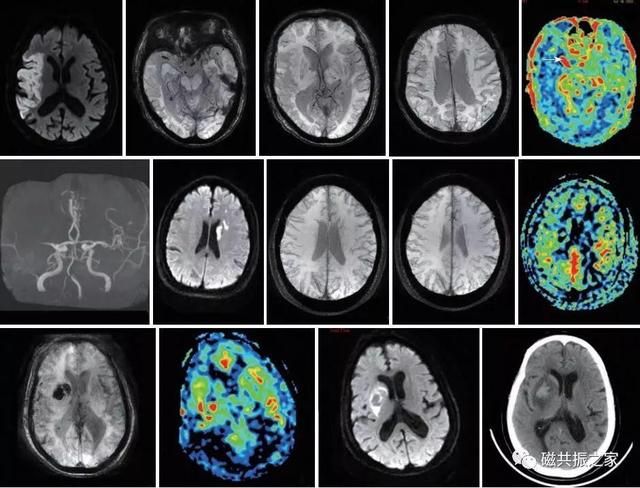 颅脑mri扫描的常用基线 颅脑MRI检查序列及临床应用(13)