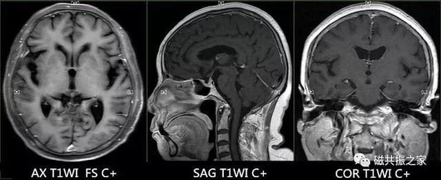 颅脑mri扫描的常用基线 颅脑MRI检查序列及临床应用(10)