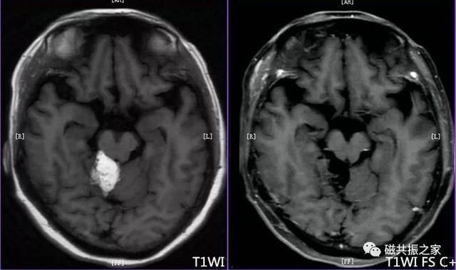 颅脑mri扫描的常用基线 颅脑MRI检查序列及临床应用(4)