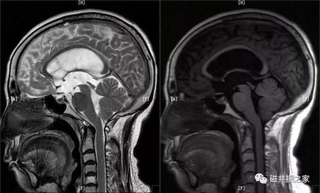 颅脑mri扫描的常用基线 颅脑MRI检查序列及临床应用(9)