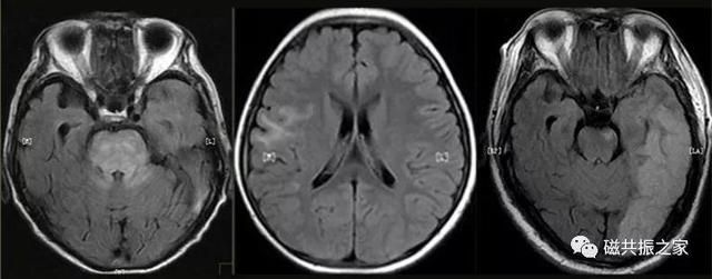 颅脑mri扫描的常用基线 颅脑MRI检查序列及临床应用(7)
