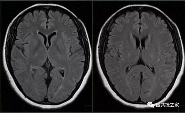 颅脑mri扫描的常用基线 颅脑MRI检查序列及临床应用(6)