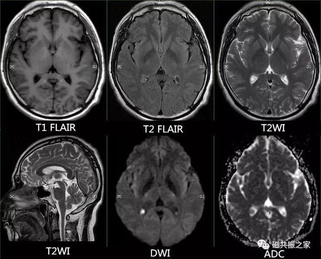 颅脑mri扫描的常用基线 颅脑MRI检查序列及临床应用(2)
