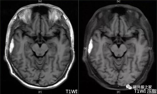 颅脑mri扫描的常用基线 颅脑MRI检查序列及临床应用(5)