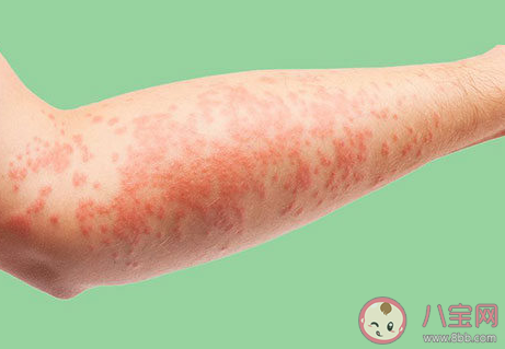 湿疹都是因为环境潮湿引发的吗 蚂蚁庄园5月25日答案