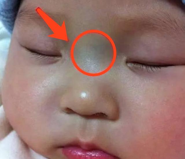 宝宝鼻梁上有“青筋”的原因是什么？