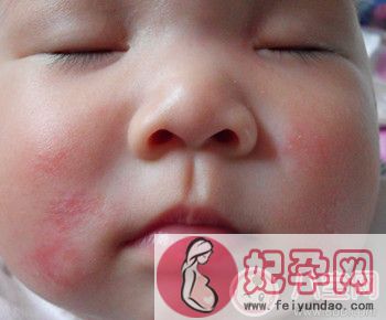 小儿湿疹的症状及治疗方法 引发湿疹的原因有哪些