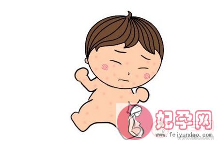 宝宝湿疹最佳治疗方法 宝宝湿疹的症状有哪些